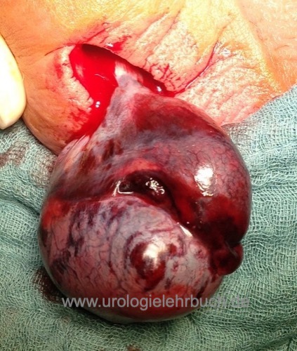 Hodenfreilegung mit h&auml;morrhagischer Hodennekrose durch eine Hodentorsion