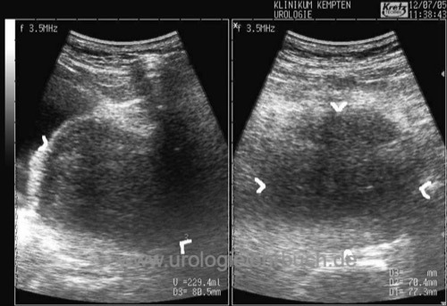 transabdominelle Messung der Prostatagr&ouml;&szlig;e mit der Sonographie