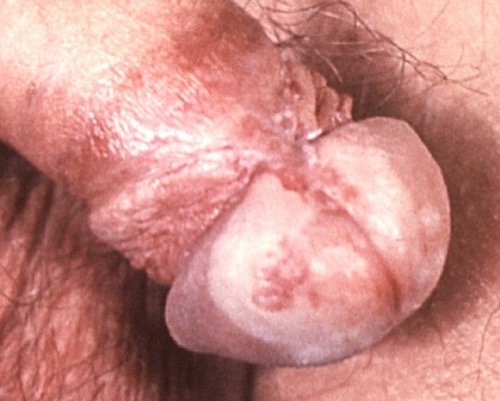Balanitis xerotica obliterans Lichen sclerosus et atrophicus Glans Penis