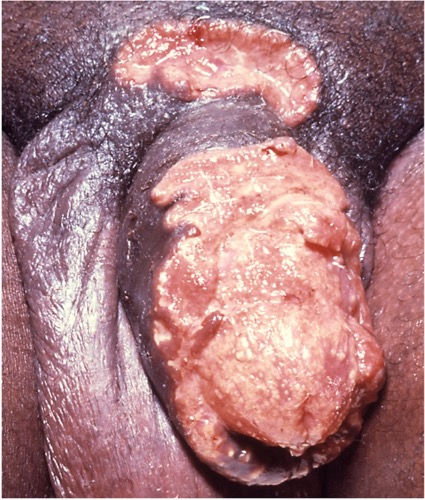 Granuloma inguinale Donovanosis