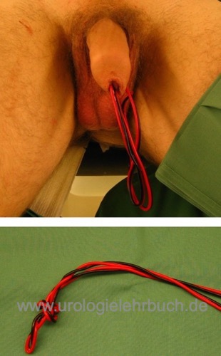 Kabel als Fremdk&ouml;rper in der Harnblase