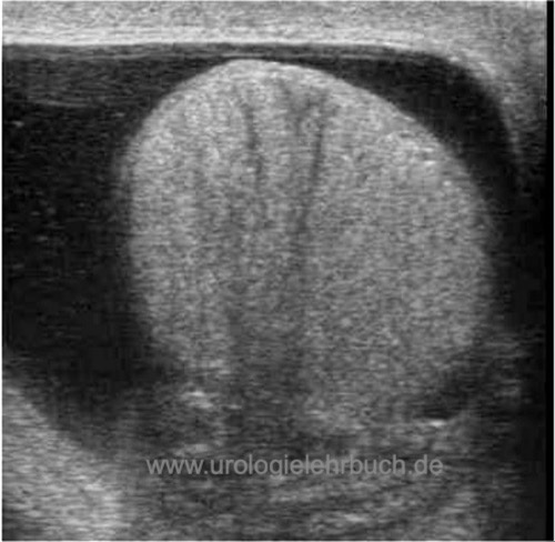 Hydrozele testis (Wasserbruch) im Ultraschall