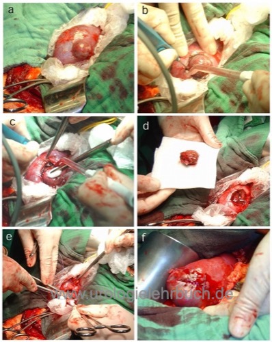Nierenteilresektion: a) Operationssitus: die Nierengef&auml;&szlig;e sind geklemmt und die Niere gek&uuml;hlt. b) und c) zirkul&auml;re Umschneidung des Tumors mit dem Elektroskalpell d) Nierenparenchymdefekt nach Teilresektion e) und f) tief durchgreifende Parenchymn&auml;hte zur H&auml;mostase. 