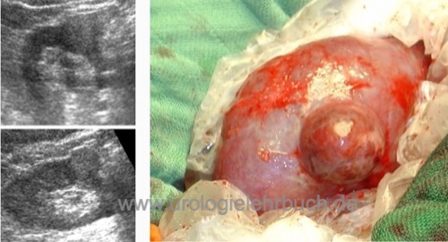 Onkozytom Nierentumor Sonographie