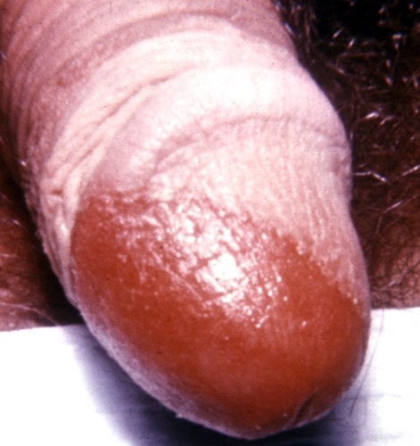 penis abbinden morbus crohn analverkehr penis abbinden morbus crohn analverkehr