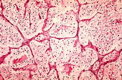 Histologie Pathologie eines konventionellen Nierenzellkarzinoms
