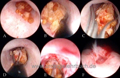 Ureterorenoskopie Dormia Extraktion Harnleiterstein Schlinge URS retrograde Pyelographie Harnleiterstein Dilatation URS