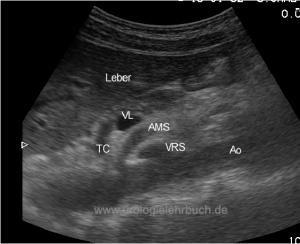 Sonographie Ultraschall der retroperitonealen Gef&auml;&szlig;e