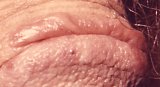 Balanitis bei Psoriasis