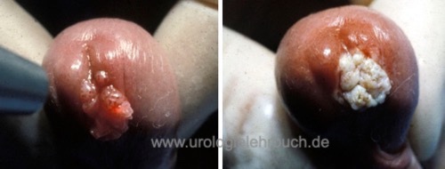 Abbildung Condylomata acuminata der Harnr&ouml;hre, vor und nach Lasertherapie