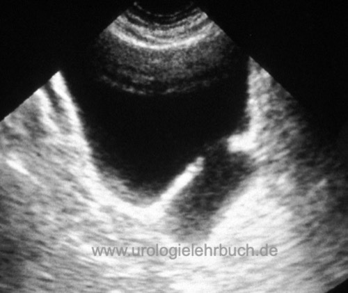 Sonographie eines Harnblasendivertikels.