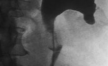 Tumor des Harnleiters