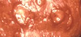 Herpes genitalis Bl&auml;schen