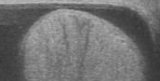 Hoden mit Hydrozele im Ultraschall