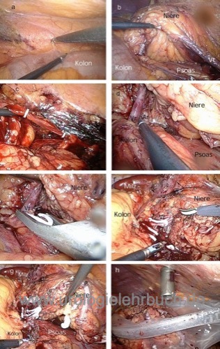 Laparoskopische Tumornephrektomie a) Kolonpr&auml;paration b) Ureter- und V. testicularis-Pr&auml;paration c) Durchtrennung der V. testicularis d) Pr&auml;paration der Hilusgef&auml;&szlig;e e) Klippen der Nierenvene f) Durchtrennung der Nierenvene g) geklippte Nierenarterie h) Organpr&auml;parat im Bergebeutel Nierenzellkarzinom