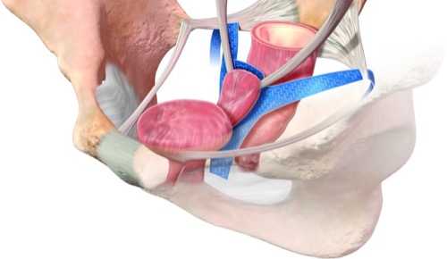 Rekonstruktion des hinteren Beckenbodens mit einem mehrarmigen Prolene-Netz (Prolift-System)