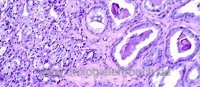 Histologie des Prostatakarzinoms