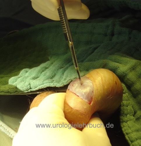 Operation Hodenfreilegung bei Hodentorsion