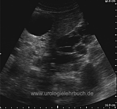 Abb. Sonographie der Nieren bei polyzystischer Nierenerkrankung (ADPKD)