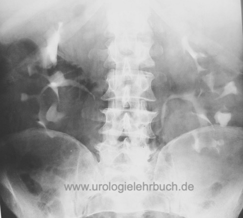  Urogramm bei ADPKD Kelchverdrängung durch multiple Zysten Autosomal dominante polyzystische Nierenerkrankung