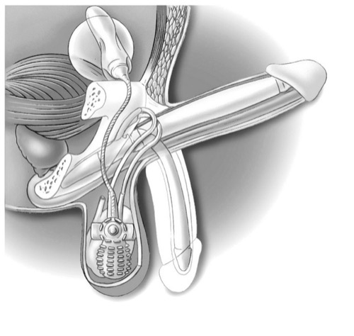 Penisprothese (AMS 700) zur operativen Therapie der erektilen Dysfunktion