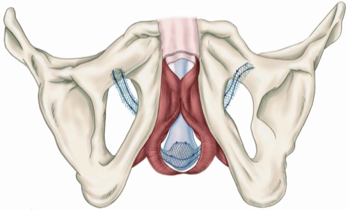 Advance-Band zur Behandlung der Belastungsinkontinenz des Mannes nach radialer Prostatektomie