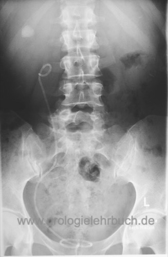 Röntgen-Abdomen Abdomenübersichtsaufnahme vor Urogramm