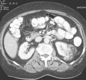 angiomyolipom Nierentumor CT Computertomographie