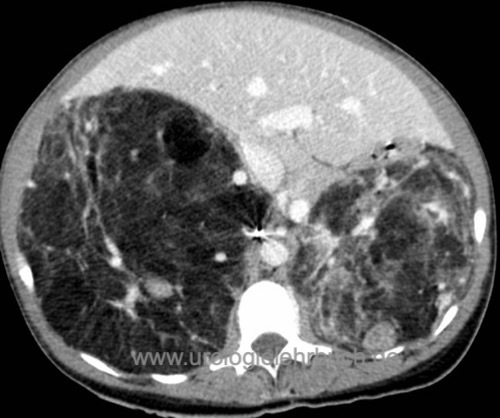 Abbildung bilaterale Angiomyolipome bei tuberöser Hirnsklerose, Computertomographie