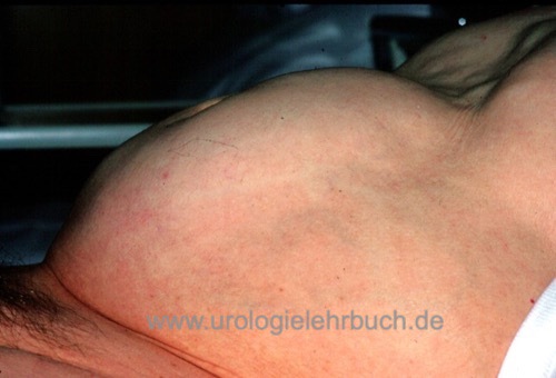 Harnverhalt durch benigne Prostatahyperplasie (BPH)