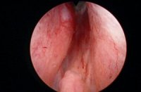 Zystoskopie Seitenlappen kissing lobes bei BPH benigne Prostatahyperplasie