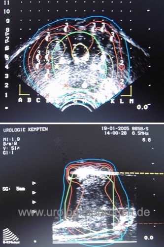 Brachytherapie Prostata intraoperative Dosimetrie Seeds Ketten Implantation Seedsposition