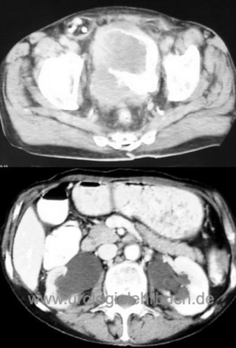  Computertomographie CT-Abdomen Harnblasenkarzinom