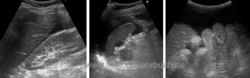 Sonographischer Nachweis von freier intraperitonealer Flüssigkeit