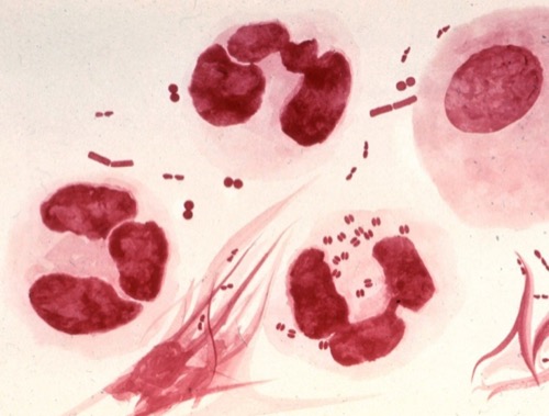 Gonorrhoe Tripper Mikroskopie Granulozyten Diplokokken Gonokokken Urethritis Geschlechtskrankheit
