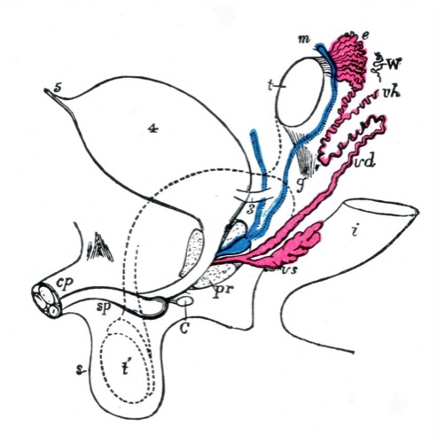 Schematische Darstellung der Genitalanlage eines männlichen Embryos Glandula bulbourethralis (C), Corpus cavernosum penis (cp), Caput epididymis (e), Gubernaculum testis (g), Rektum (i), Müller-Gang Morgagni-Hydatide  Prostata die Utrikuluszyste, Wolff-Gang Skrotum (s), Corpus spongiosum (sp), Testis (t) und Descensus (t’), Ductus deferens (vd), Fehlbildung des Ductus deferens (vh), Vesicula seminalis (vs), Paradidymis (Giraldés-Organ) (W), Ureter (3), Harnblase (4), Urachus (5)