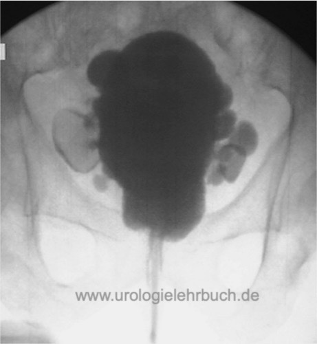 Zystogramm Harnblasendivertikeln bei der benignen Prostatahyperplasie (BPH)