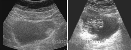 Harnblasenkarzinom Blasenkrebs Sonographie