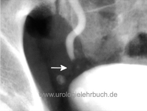 Urogramm Füllungsdefekt im distalen Harnleiter als Zeichen eines nicht schattengebenden Harnleitersteins Nephrolithiasis