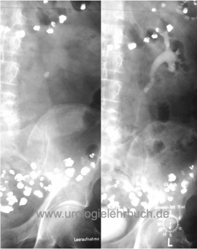 Urogramm proximaler Harnleiterstein links mit Harnstau II Grades