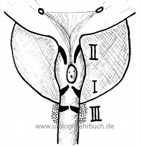 Harnröhrenklappen Young Einteilung Fehlbildung Harnröhre