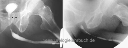 Retrograde Urethrographie der Harnröhrenstriktur Harnblasenhalsstriktur nach TURP mehrere penile und bulbäre Harnröhrenstrikturen