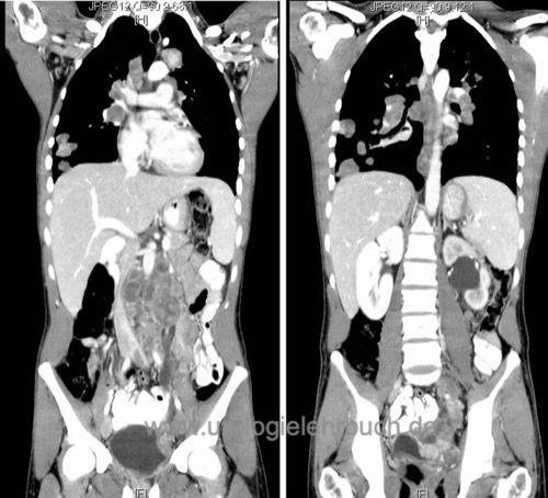 Abbildung CT-Abdomen und Thorax, frontale Rekonstruktion: multiple retroperitoneale, iliakale  Lymphknotenmetastasen bei einem linksseitigem Nichtseminom des Hodens, welche eine Harnstauungsniere links verursachen. Zusätzlich multiple Lungenmetastasen.