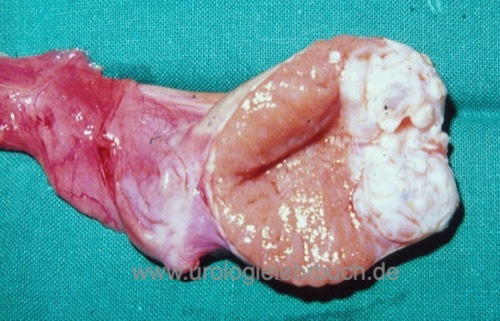 Orchiektomie-Präparat: der longitudinal aufgeschnittene Hoden zeigt einen Hodentumor (Histologie Seminom) am Unterpol des Hodens