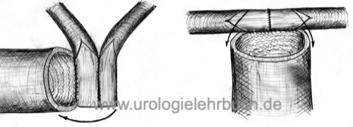 Schema Harnleiterimplantation in ein Ileum-Conduit Harnableitung nach Zystektomie Harnblasenkarzinom
