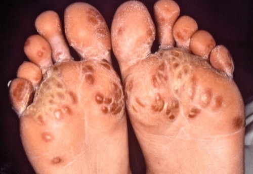 Keratoma blennorrhagicum: im Rahmen eines Reiter-Syndroms entstehende übermäßige Verhornung an den Handflächen oder Fußsohlen nach Urethritis
