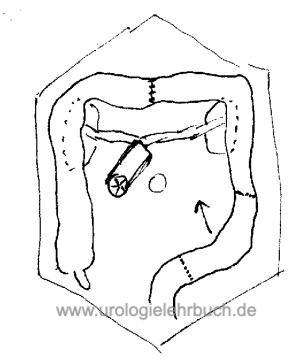 Schema Kolon-Conduit Harnableitung nach Zystektomie Harnblasenkarzinom