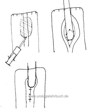 Schema Harnleiterimplantation in ein Kolon-Conduit Harnableitung nach Zystektomie Harnblasenkarzinom