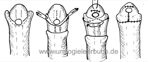 Hypospadie Operation nach MAGPI Duckett