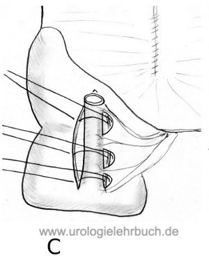 Appendix Stoma MAINZ Pouch 1 Harnableitung nach Zystektomie Harnblasenkarzinom